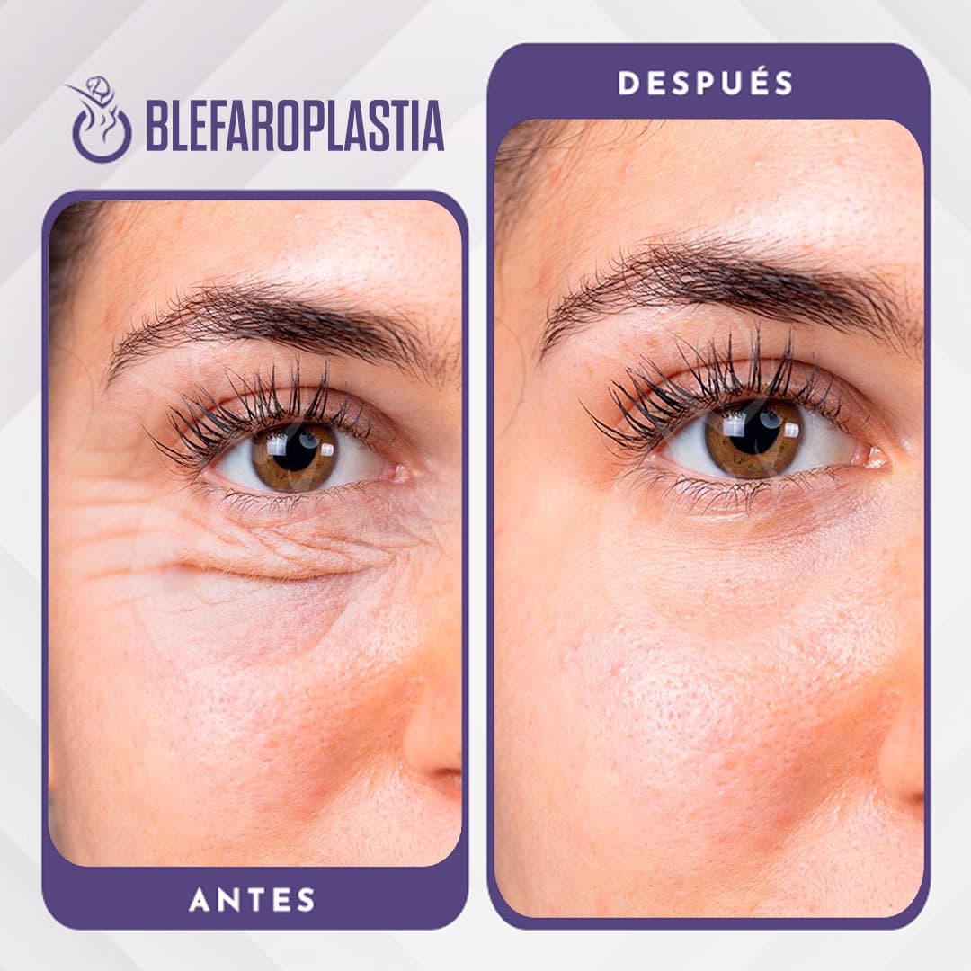 Blefaroplastia: cómo rejuvenecer tu mirada sin grandes cambios