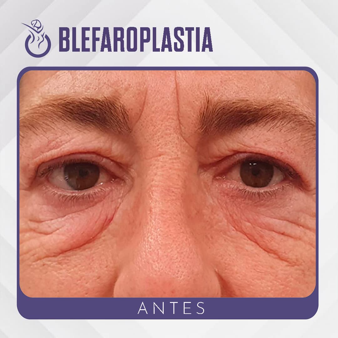 Antes