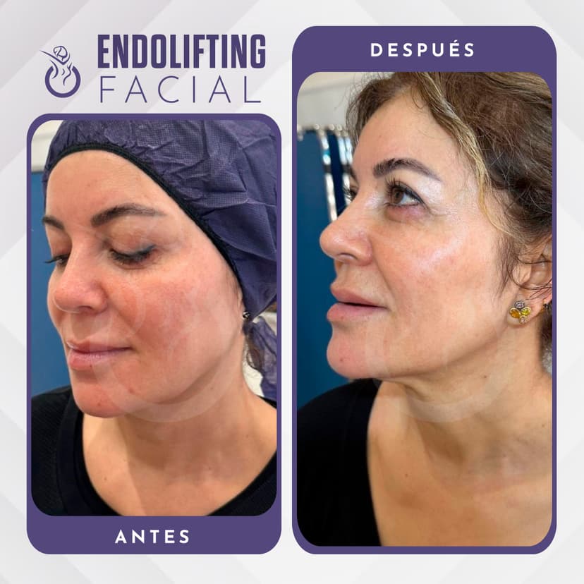 Lifting facial