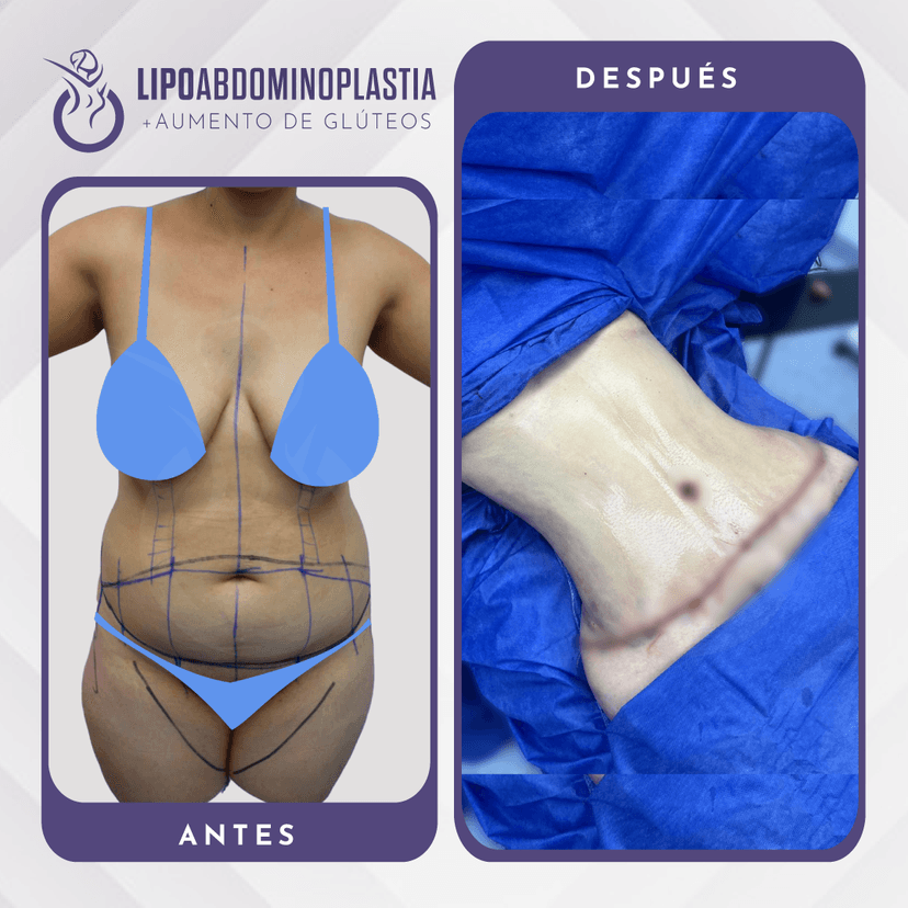 Abdominoplastia