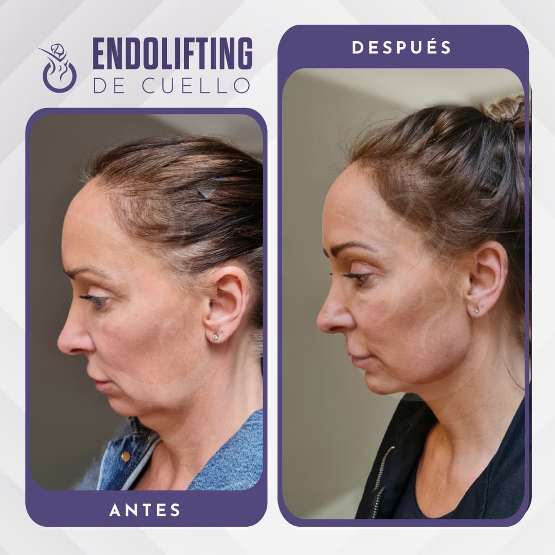 Rinoplastia: mitos y realidades que debes conocer