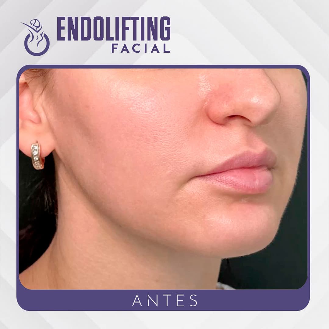 Endolifting - Antes