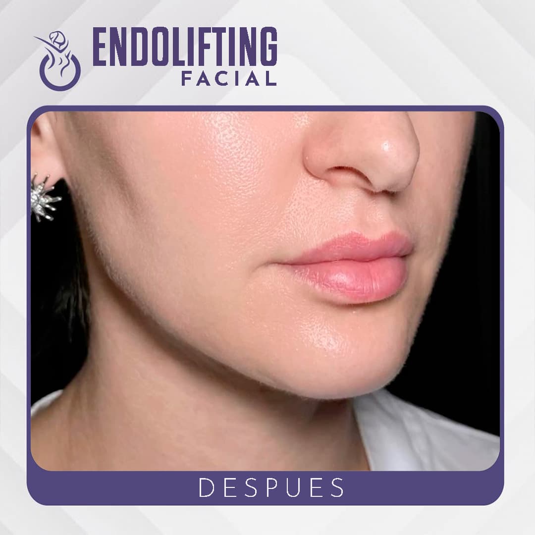 Endolifting - Después
