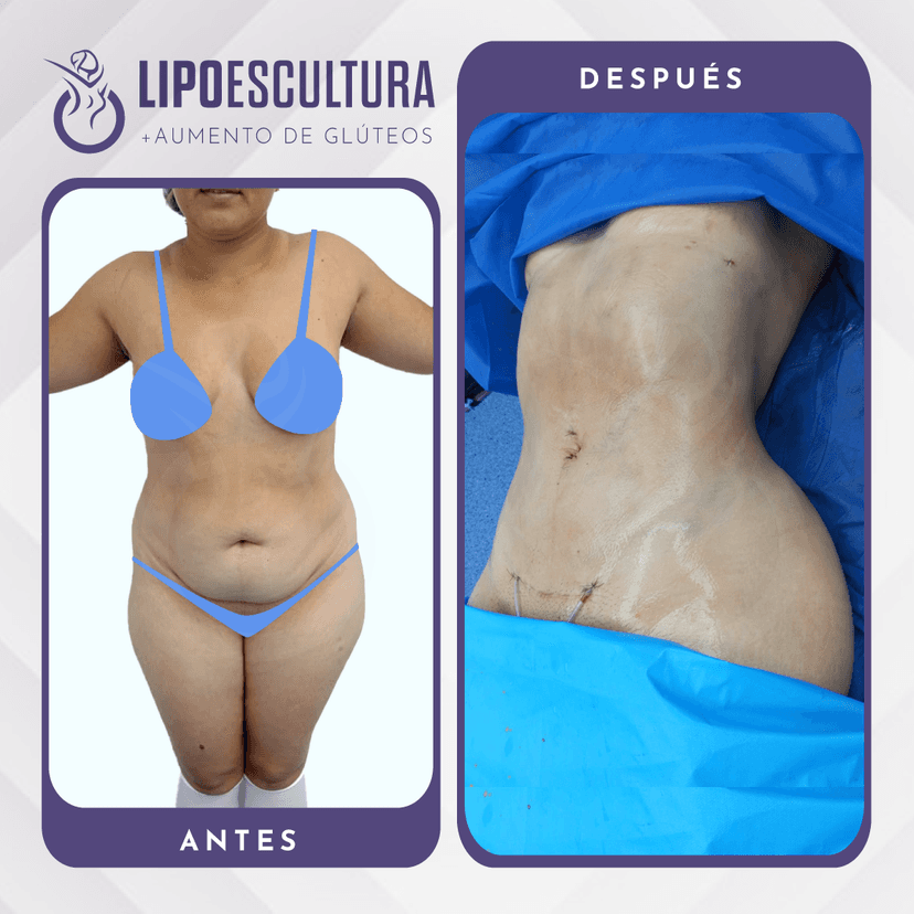 Lipoescultura