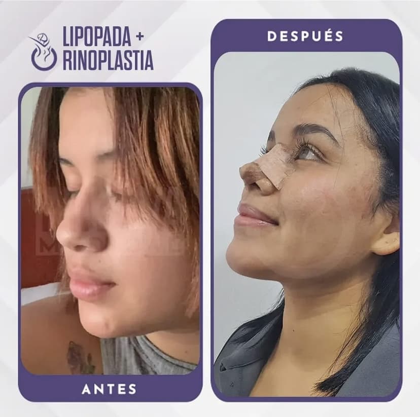 Lipopapada + Bichectomía