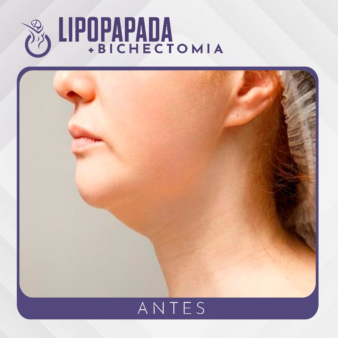 Lipopapada + Bichectomía - Antes