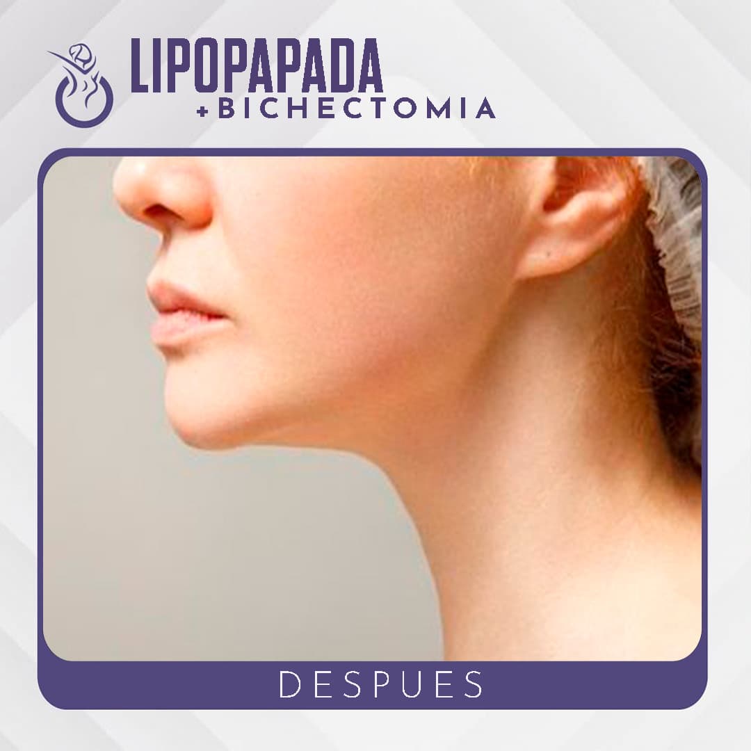Lipopapada + Bichectomía - Después