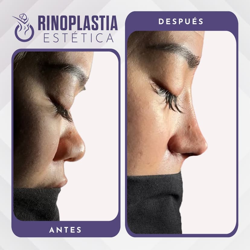 Rinoplastia