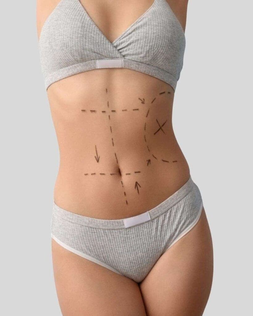 Procedimiento de abdominoplastia