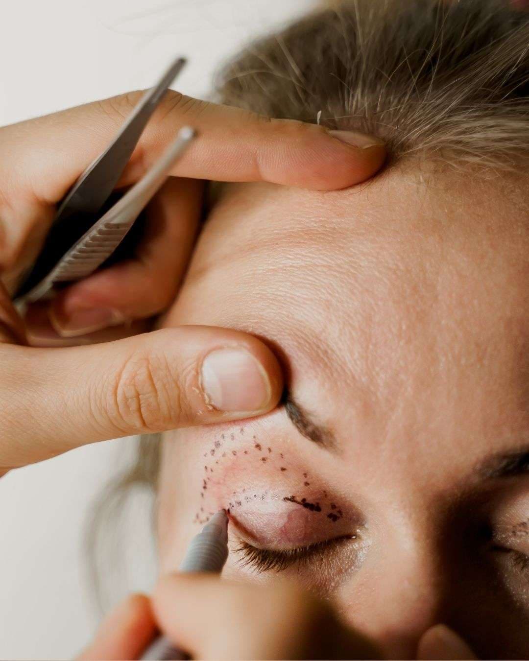 Procedimiento de blefaroplastia