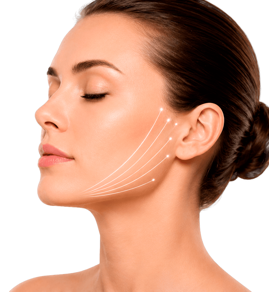 Resultado después de endolifting