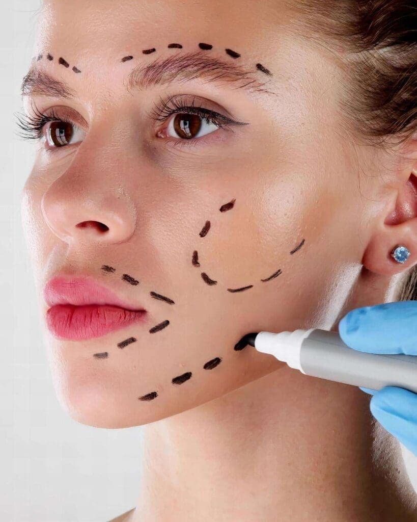 Procedimiento de lifting facial