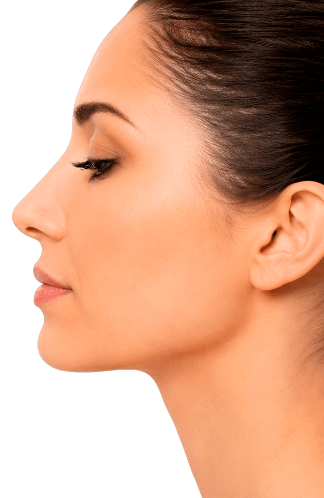 Resultado después de rinoplastia