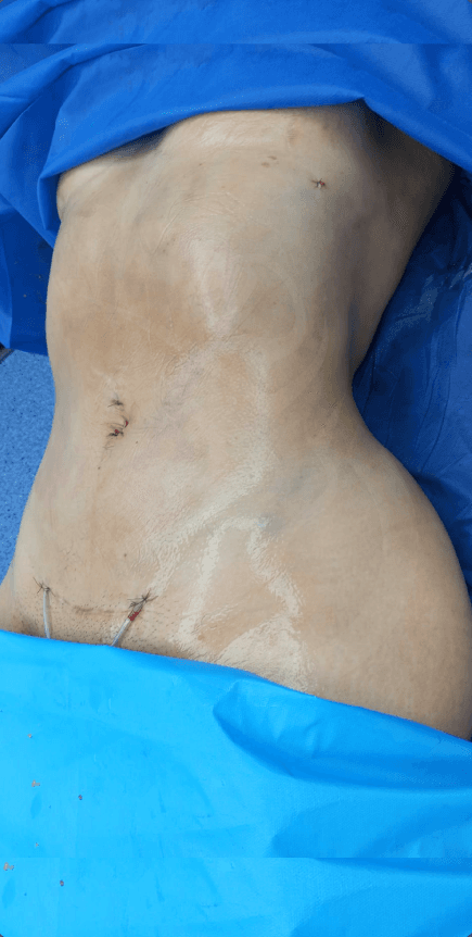Caso de éxito lipoescultura 5