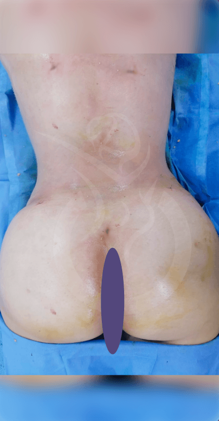 Caso de éxito lipoescultura 6